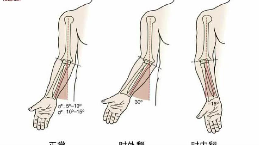 最新矫正技术，肘内翻的解决方案