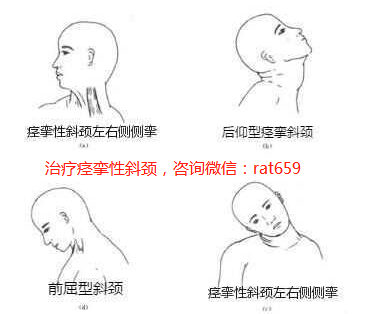 痉挛性斜颈的最新治疗方法研究