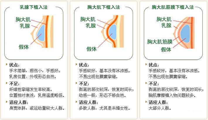 最新隆胸方法揭秘，如何选择适合自己的丰胸方式？