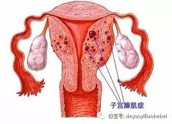 子宫腺肌症最新治疗方法解析